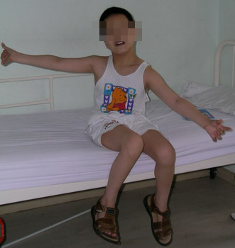 小儿脑瘫长大后会好吗