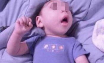 癫痫应该做哪些方面的检查